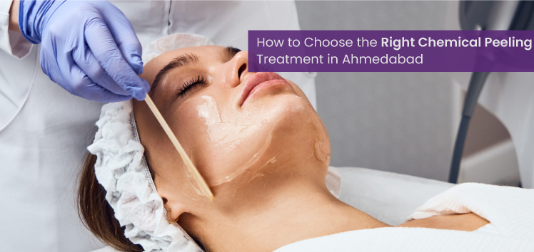 Chemical peeling treatment in Ahmedabad