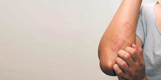 Tinea Infections
