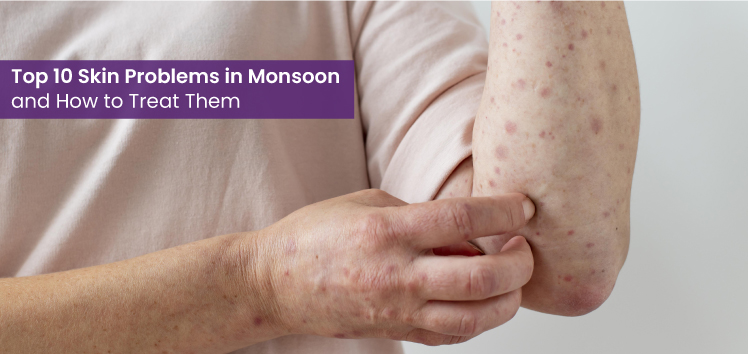 Skin Problems in Monsoon