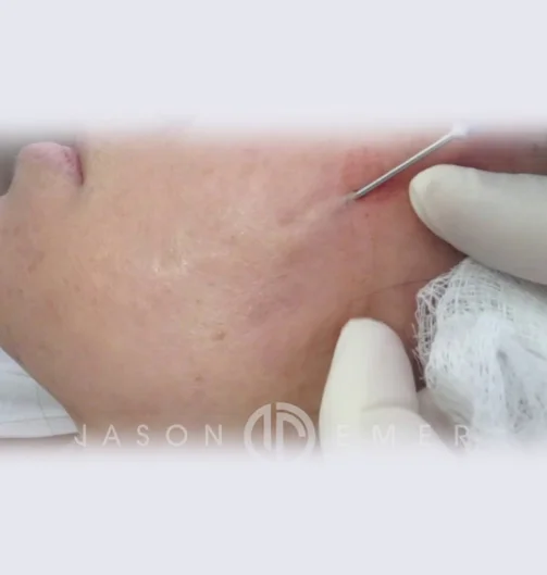 Subcision treatment near me