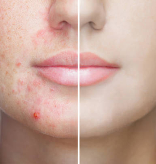 Acne Treatment in Ahmedabad